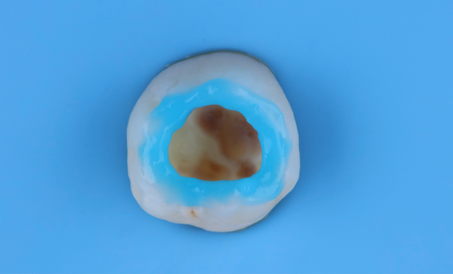 course-Direct-posterior-restoration-3